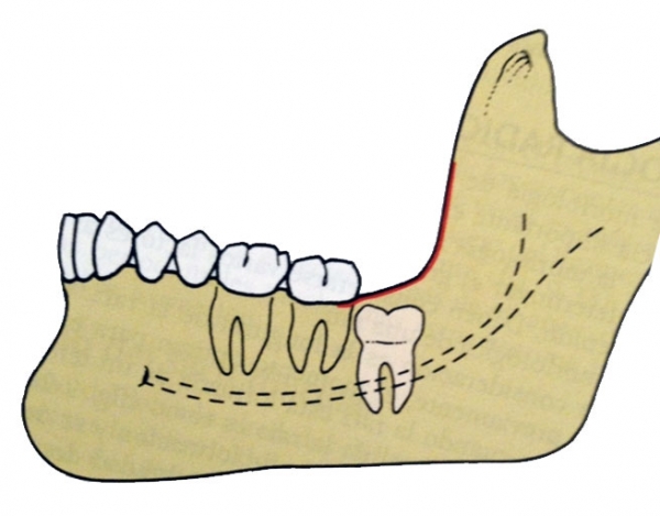 Cirugía de Terceros Molares