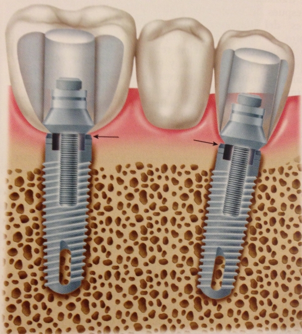 Implantes Dentales